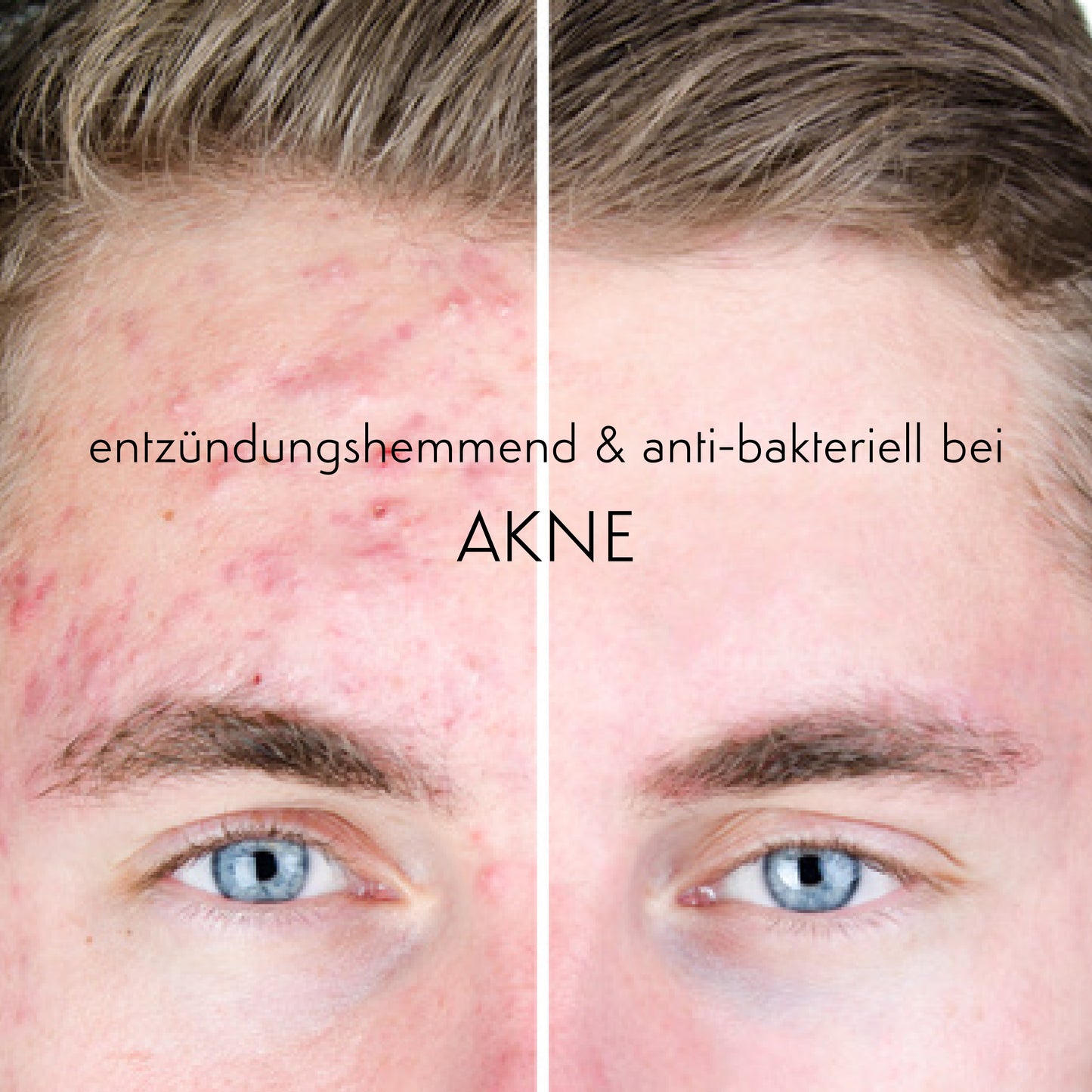 SONNENFALTEN & AKNE 2er-Set - Phyto Gold Gel