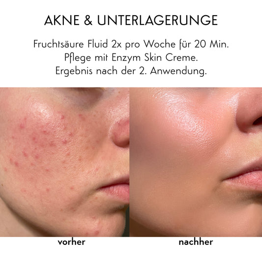 STARKE AKNE & AKNE NARBEN - Fruchtsäure Fluid & Phyto Gold-Set