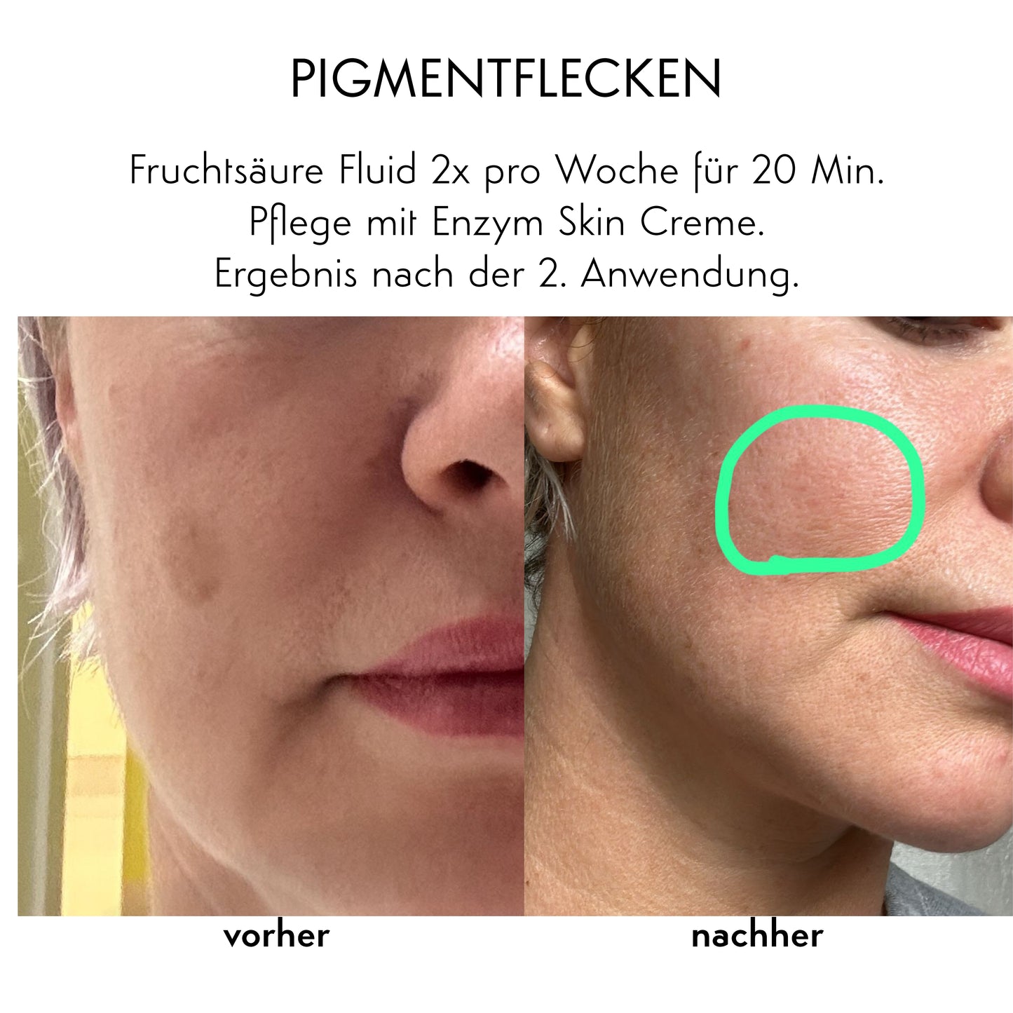 PIGMENTFLECKEN & MITESSER - Fruchtsäure Fluid & Enzym Creme-Set