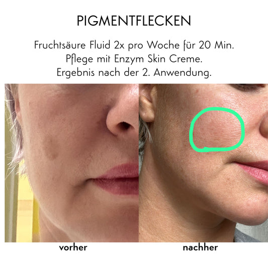 Akne & Glow - Starter Set