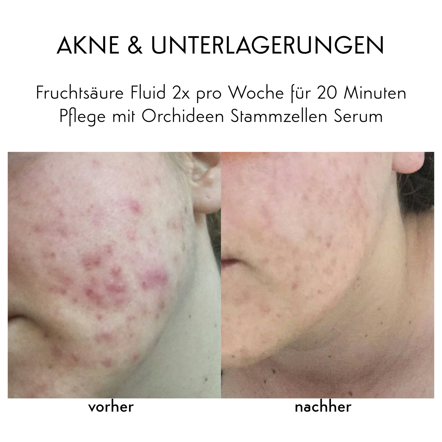 PIGMENTFLECKEN & MITESSER - Fruchtsäure Fluid & Enzym Creme-Set