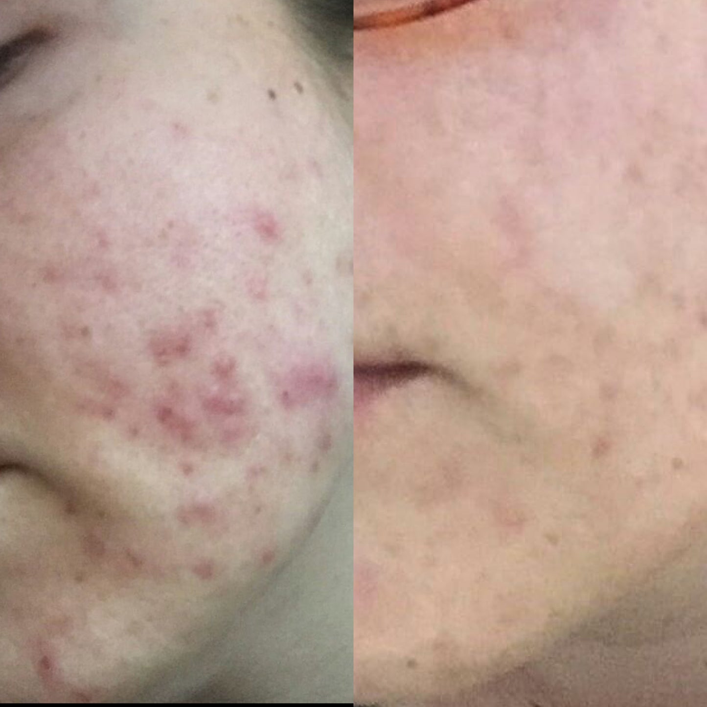 Akne & Repair- bei trockener Akne Haut