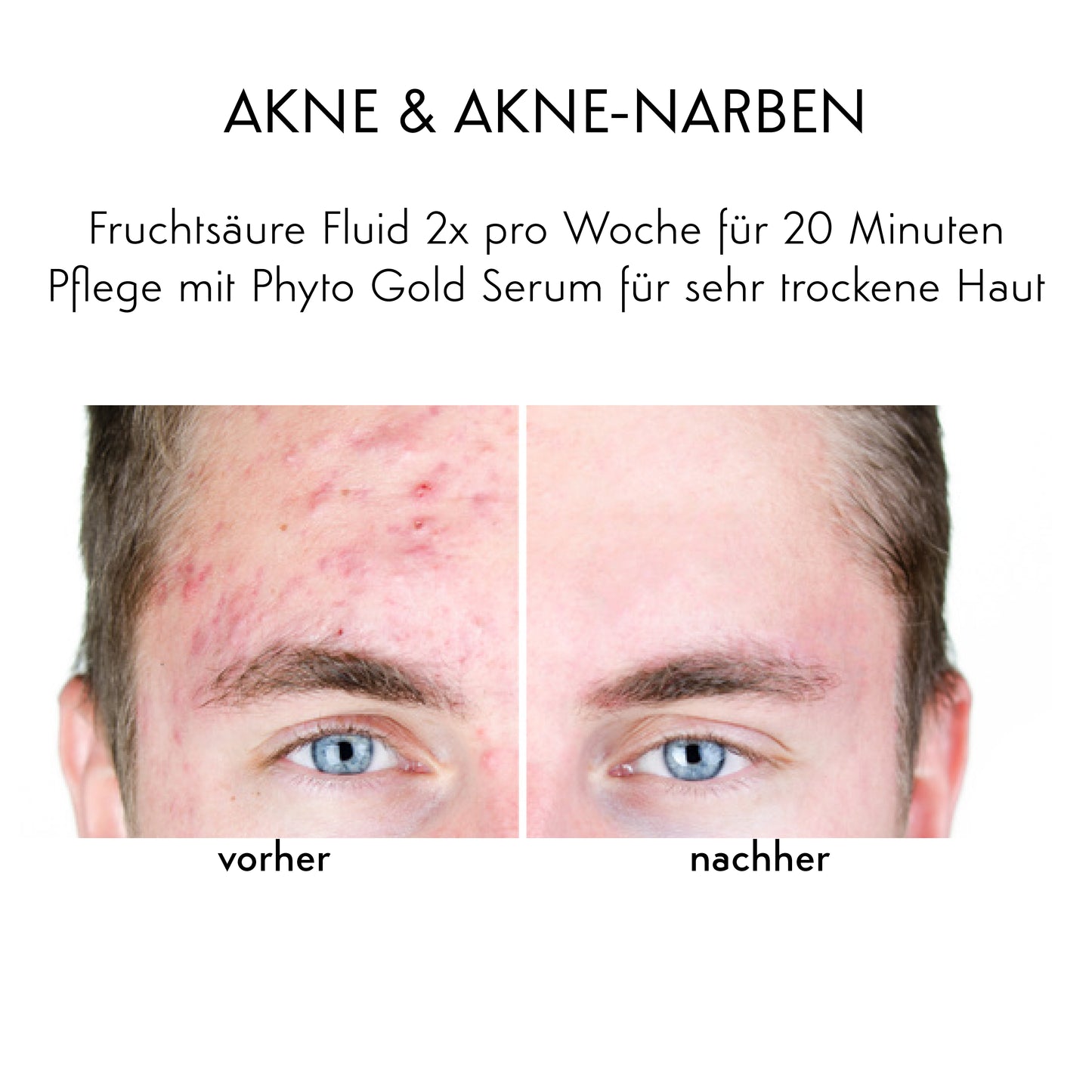 AKNE/ PIGMENTFLECKEN/ NARBEN/ POREN - Fruchtsäure Fluid + Enzym Creme 15ml gratis