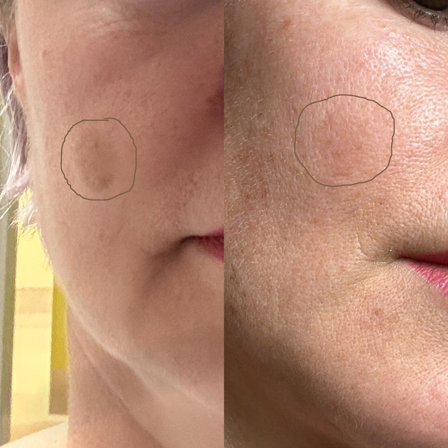 Akne & Pigmentflecken - komplett-Set bei normaler Mischhaut